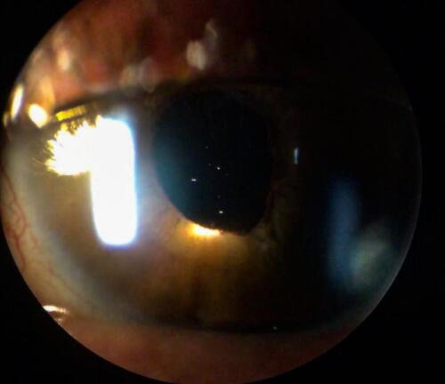 Drops of emulsified silicon oil in the anterior chamber